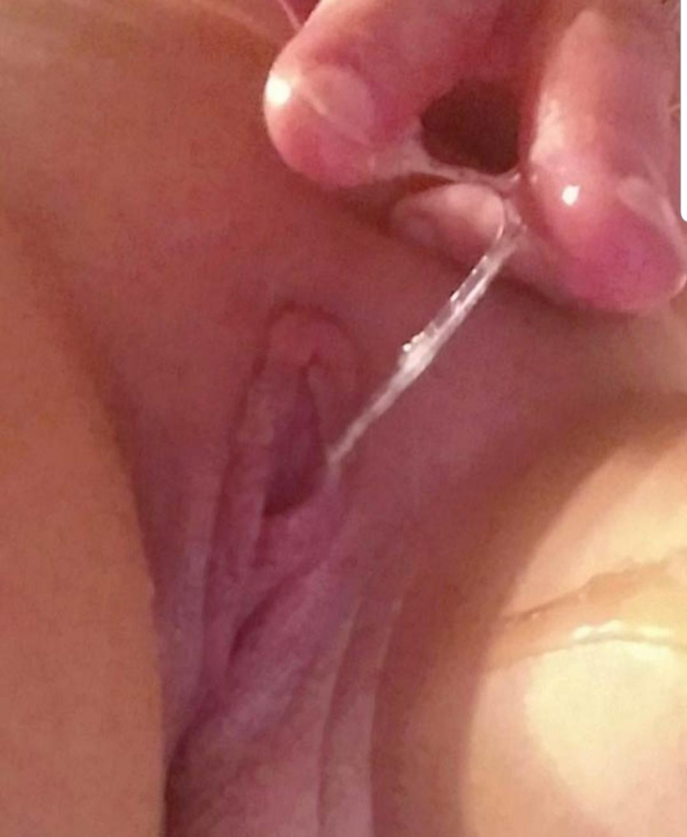 Creamy white discharge from vagina