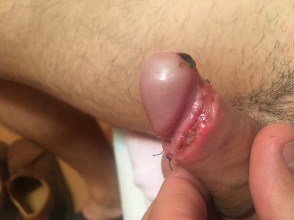 Fimosis of the extreme flesh of the penis