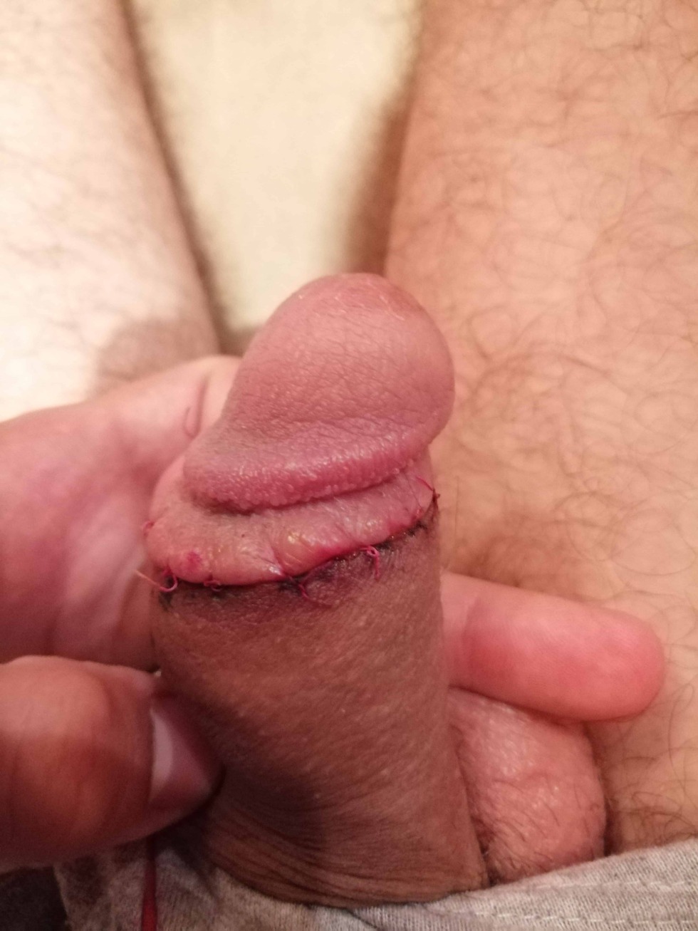 Penis with an open head