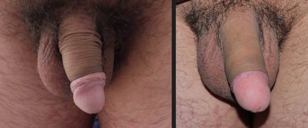 Examination of the guys penis of the foreskin