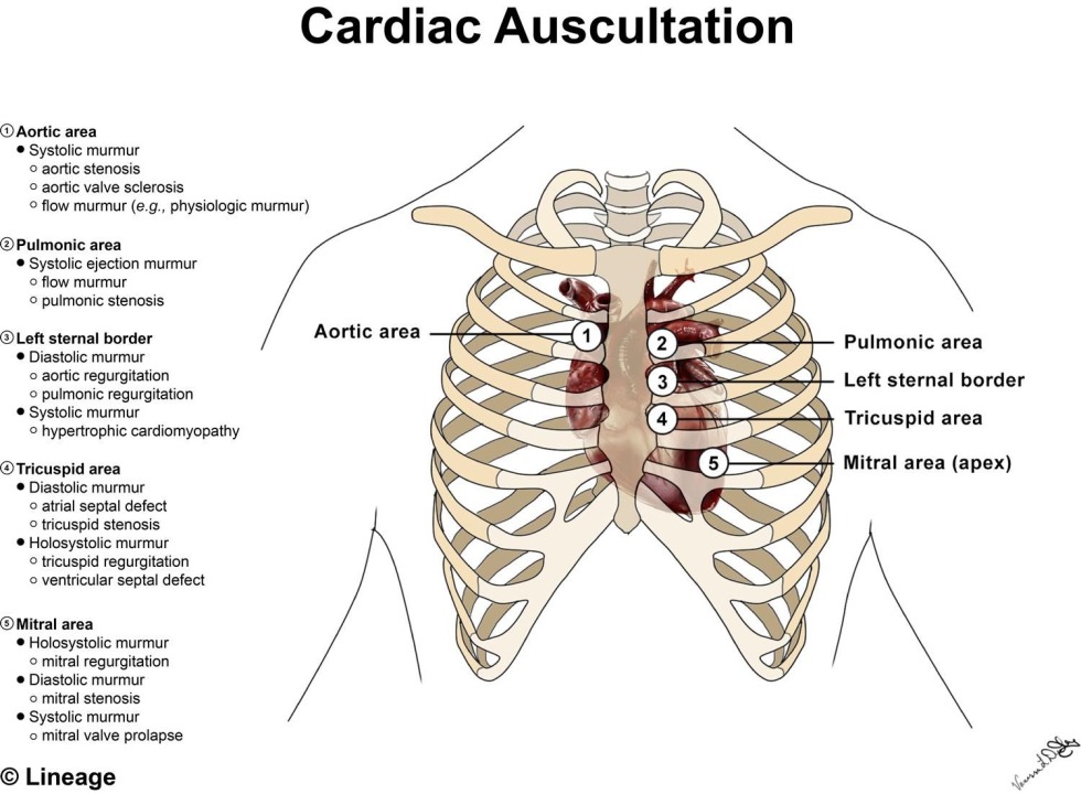 Complications of Myocardial Infarction