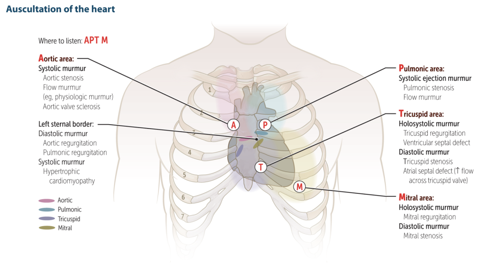 Atrial and ventricular extrasystole on the ECG