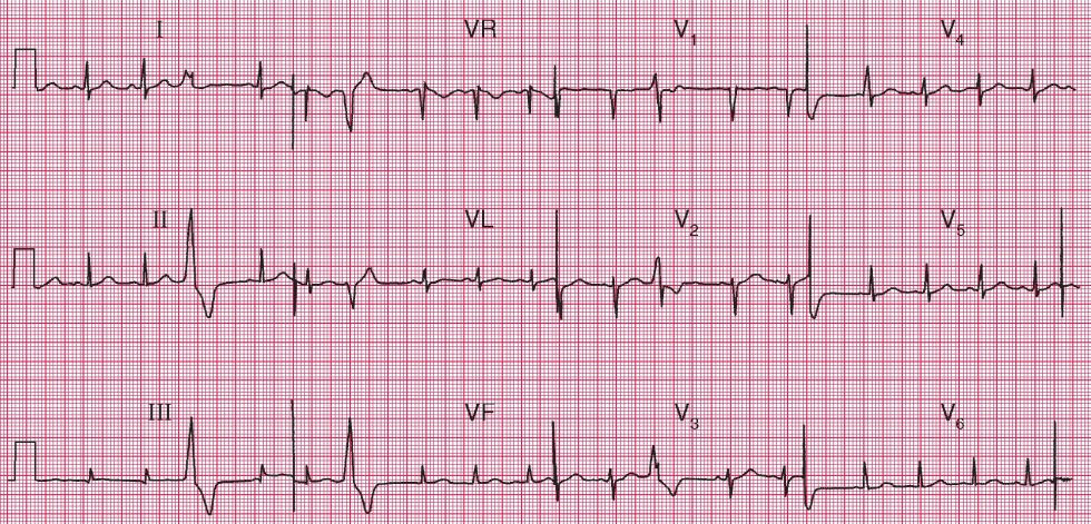 Physiological S3 Heart Sound