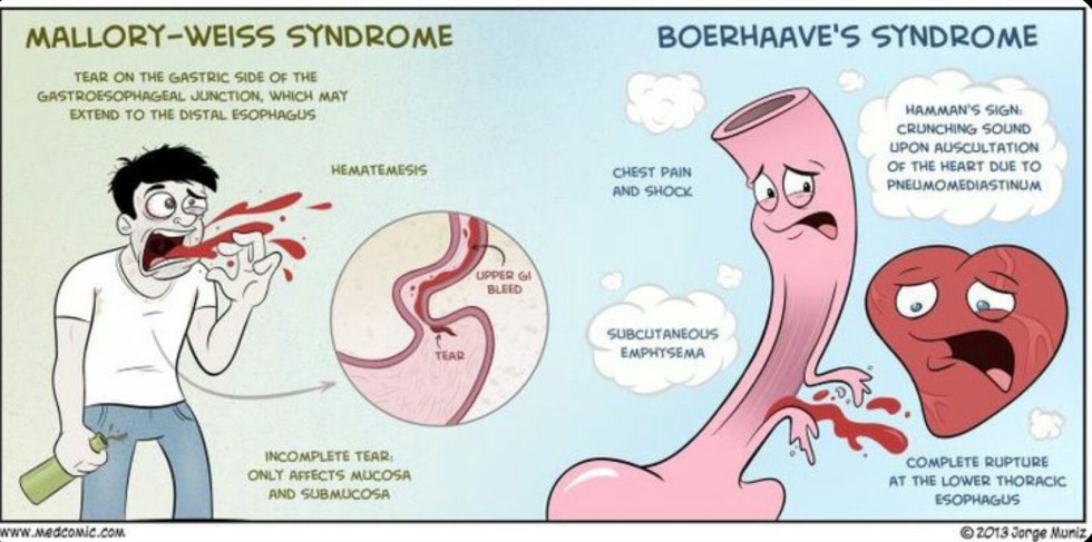 Mallory Vaisa Patanatomy syndrome