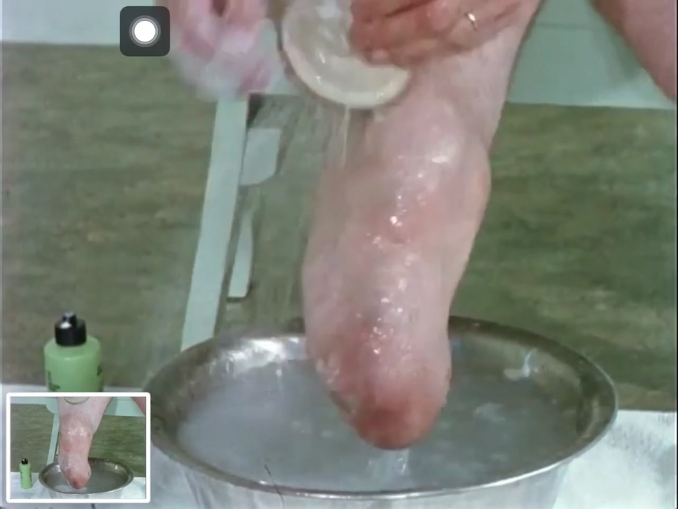 Naked Girl with Dickles Amputation Penis