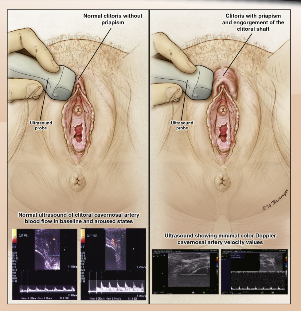 Women with a large clitoris