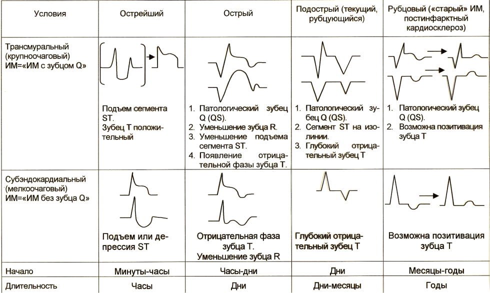 Myocardial infarction classification ECG