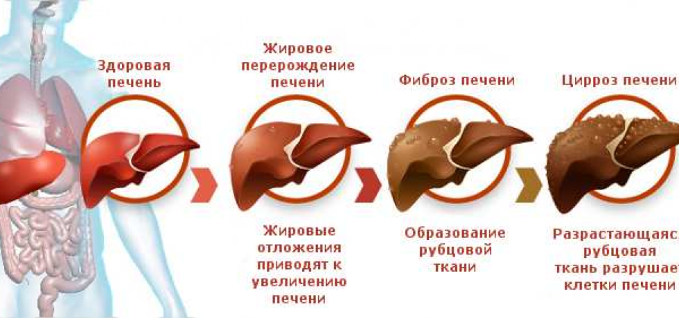 Stages of liver damage to alcohol