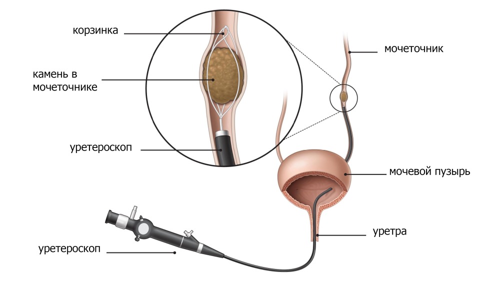Ureteral stone endoscopic operation