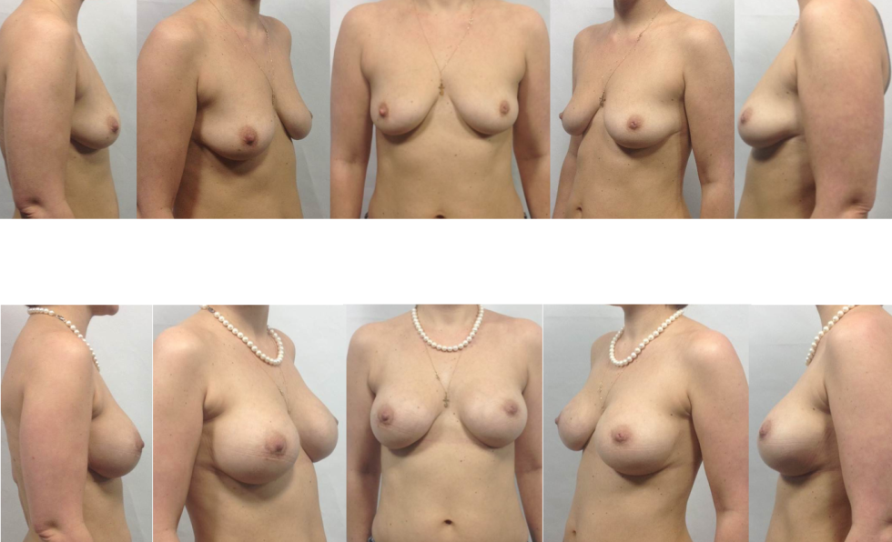 Forms of naked female breast