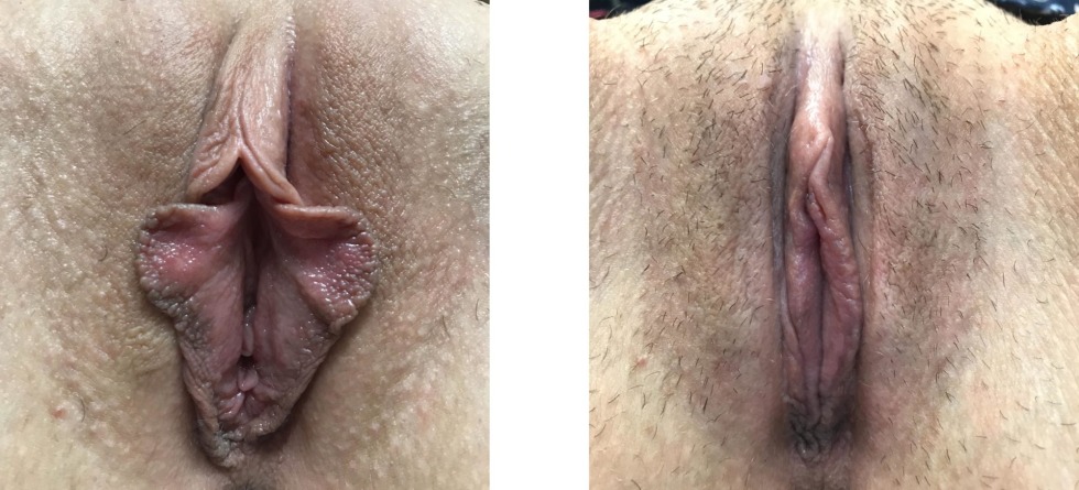 The vagina of an adult woman