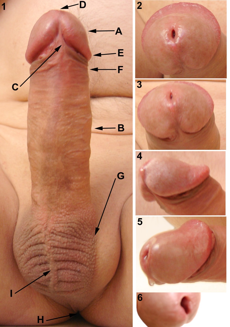 The slotted meatus of the penis