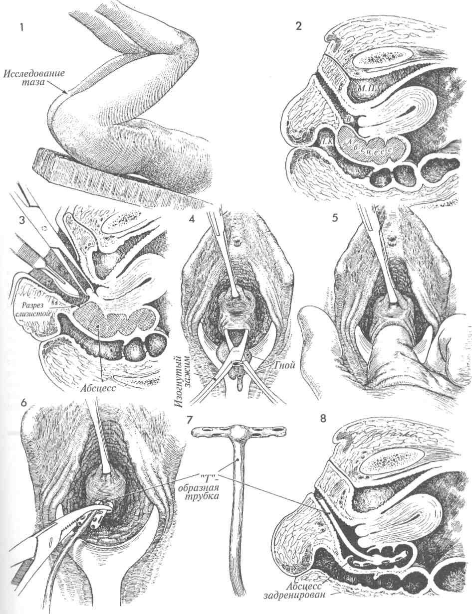 Vaginal scheme in context