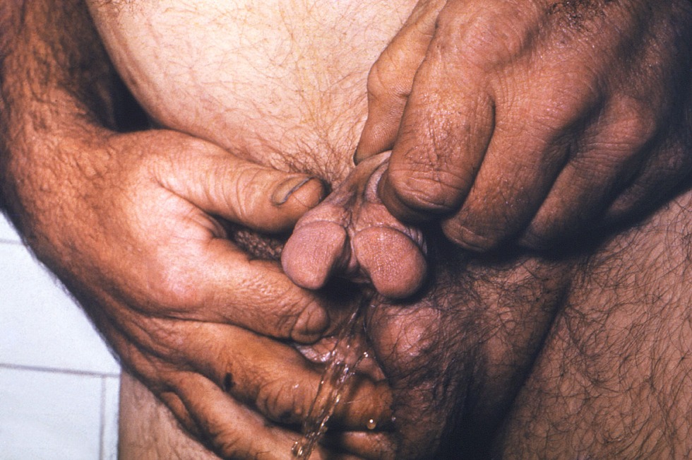 Unusual genital organs in men