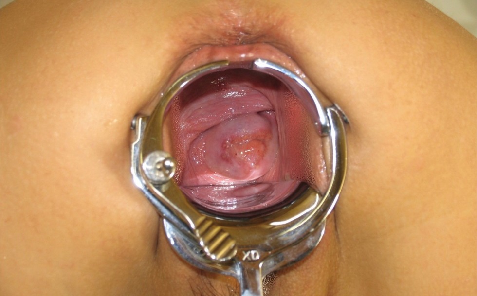 Gynecological mirror in the anus