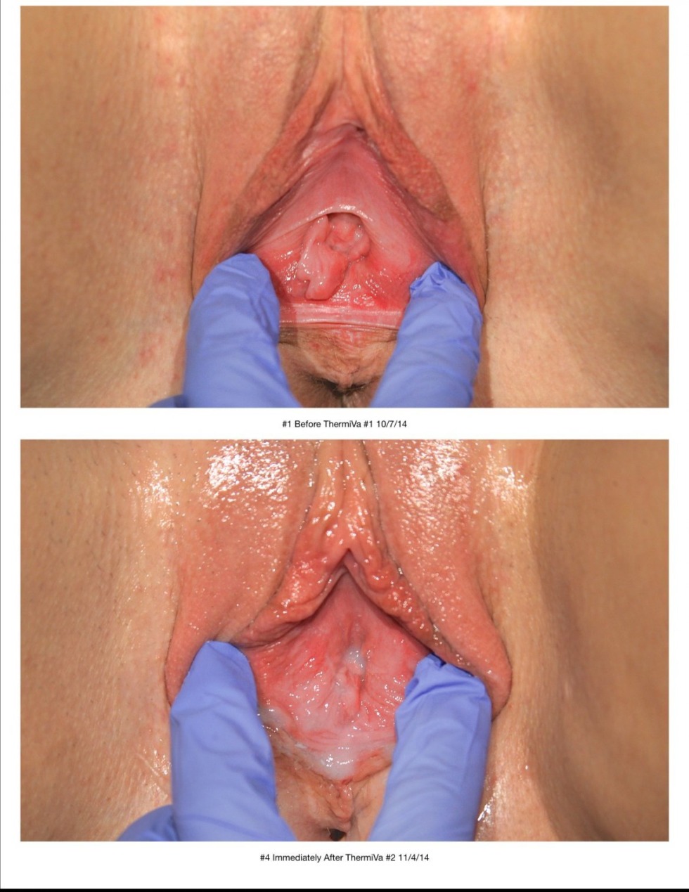 Vaginal loss after childbirth