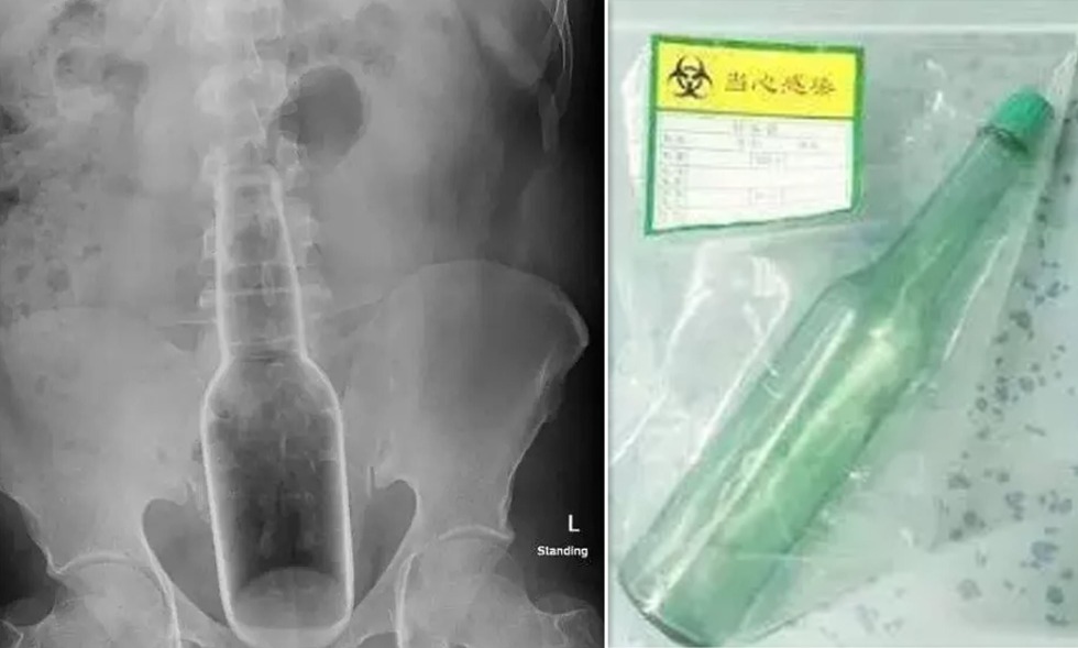 Radiography of a bottle in the rectum