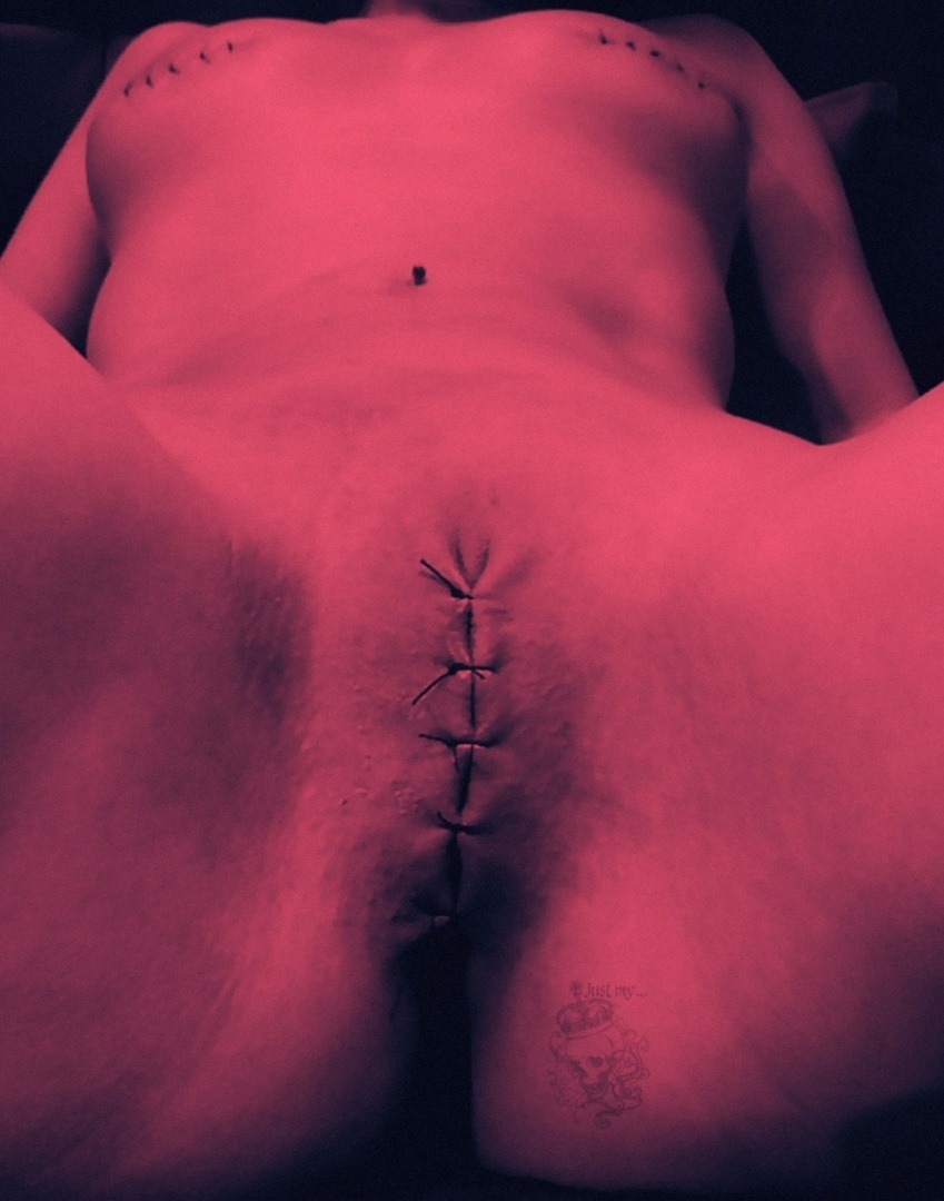 Girls with a stitched vagina