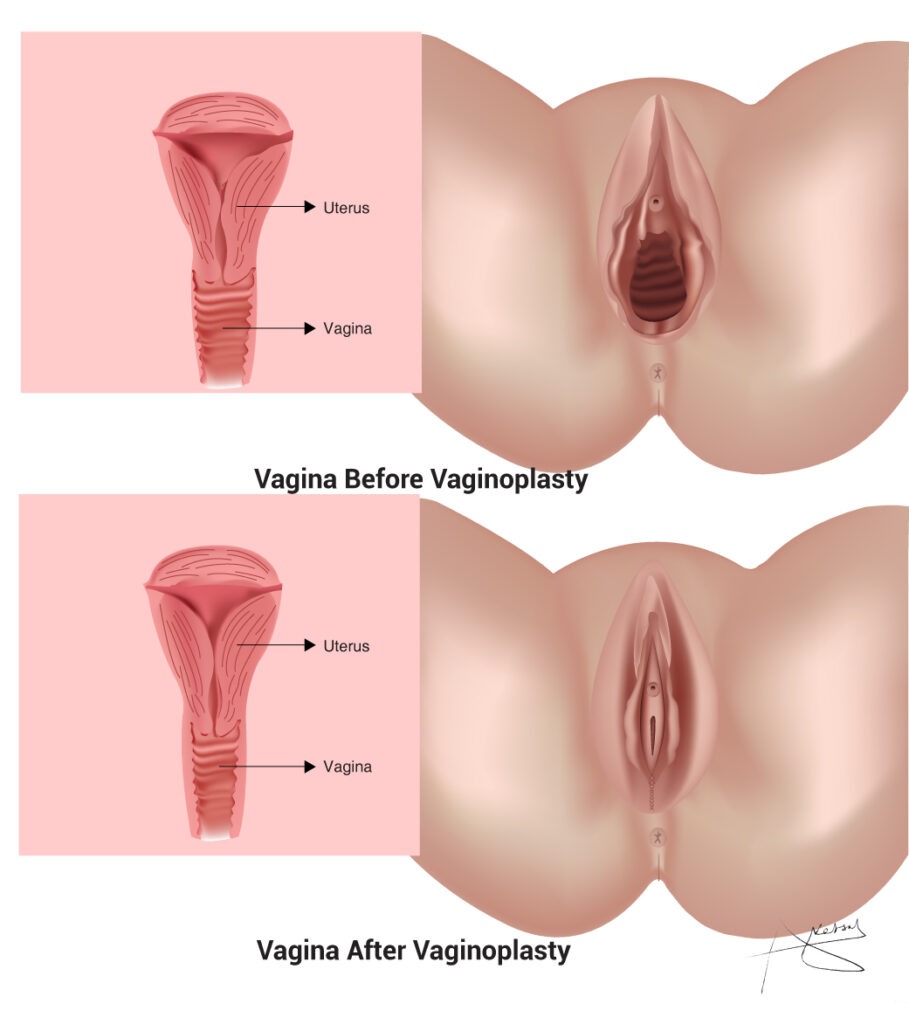Vaginal formation
