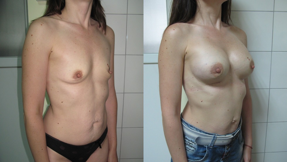 Beautiful tits zero size