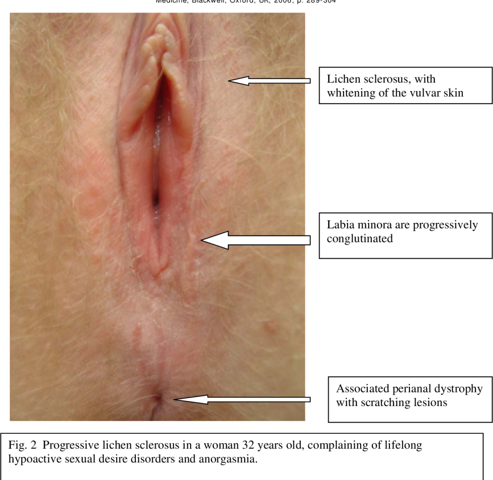 The structure of the genitals in girls