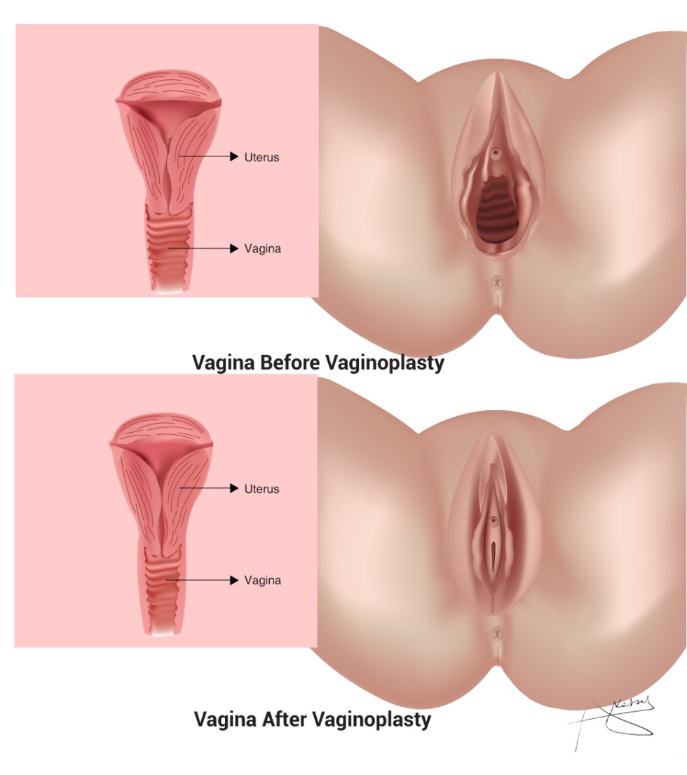 Vaginal formation