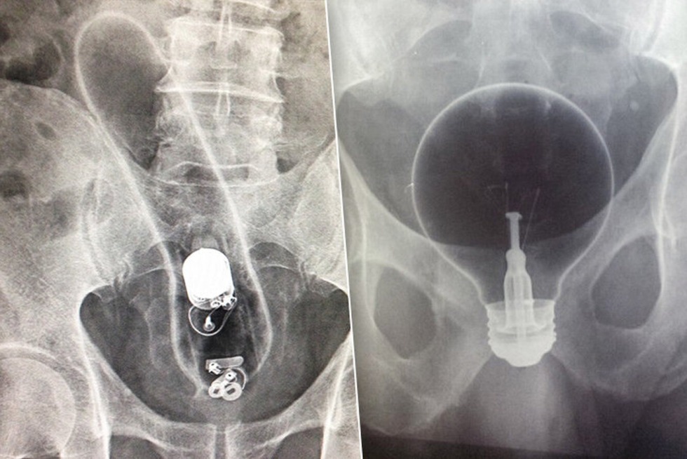 Unusual objects in the anus