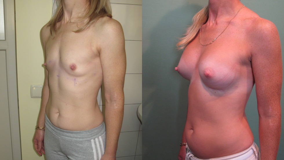 The zero boobs are private