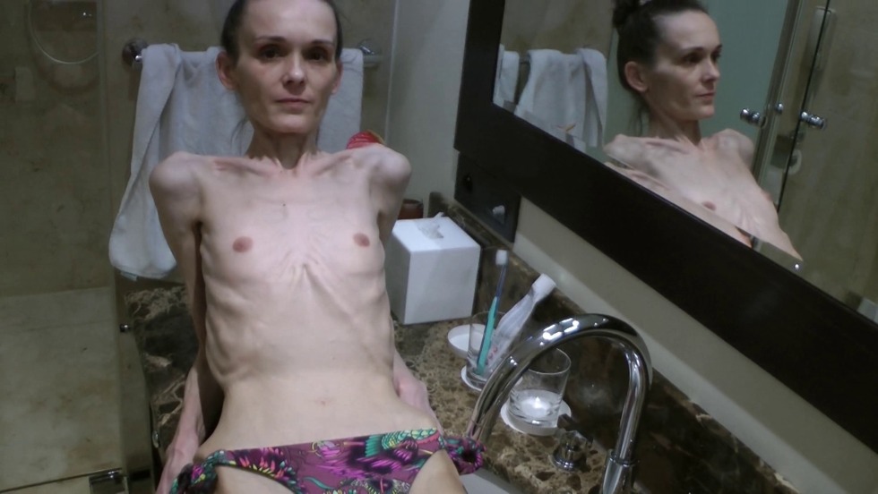 Naked women anorexics