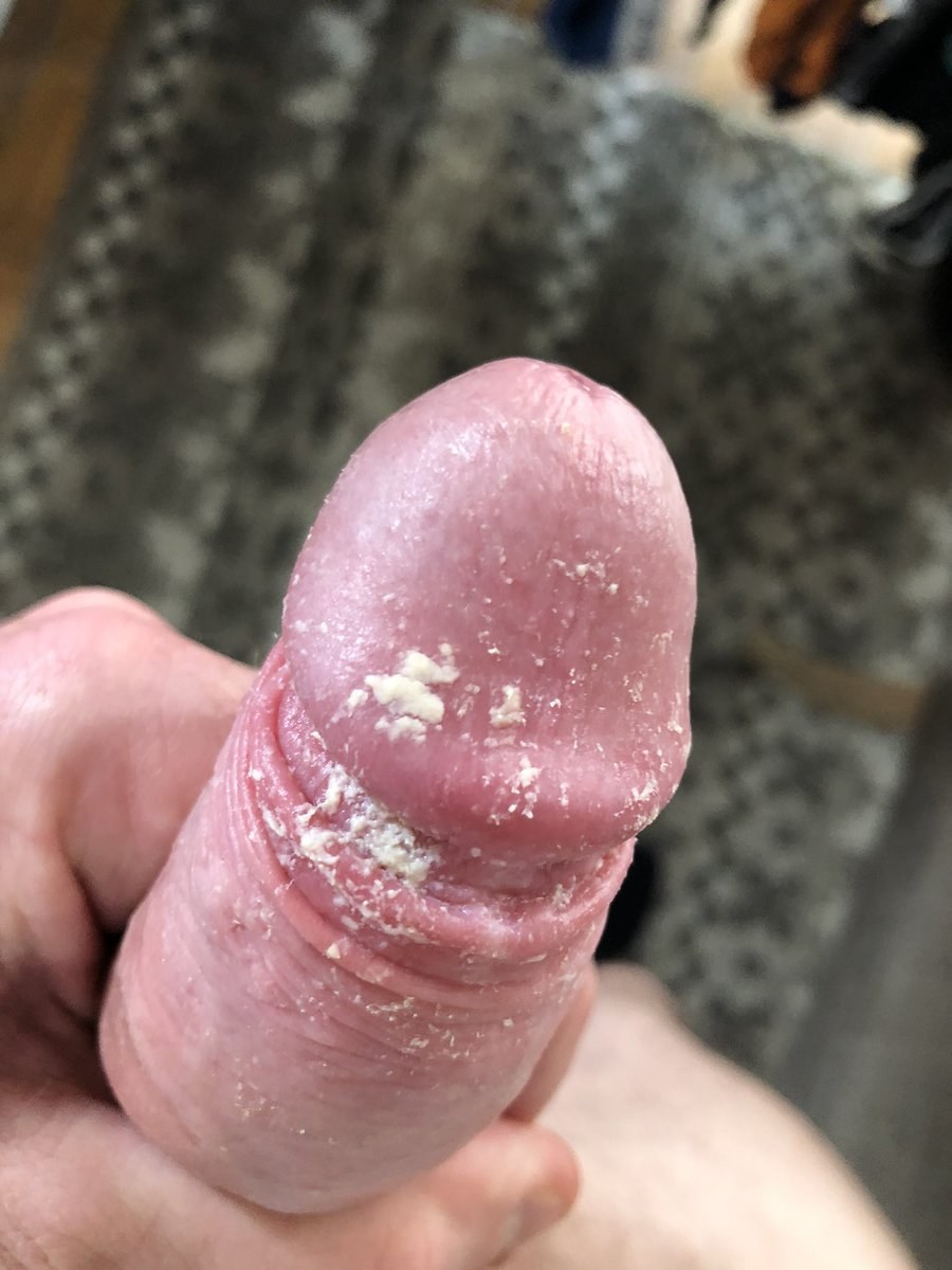 Schegma uncircumcised member