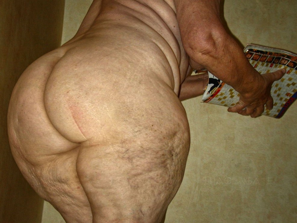 Huge cellulite sank