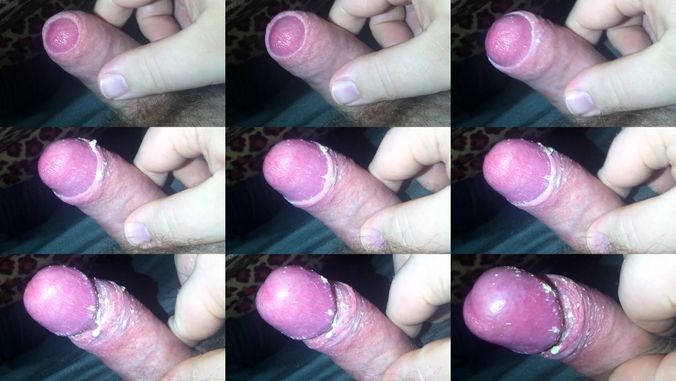 Dick smegris in adolescents