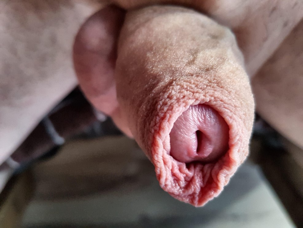 Autocircumcision with Silicone Glans Ring