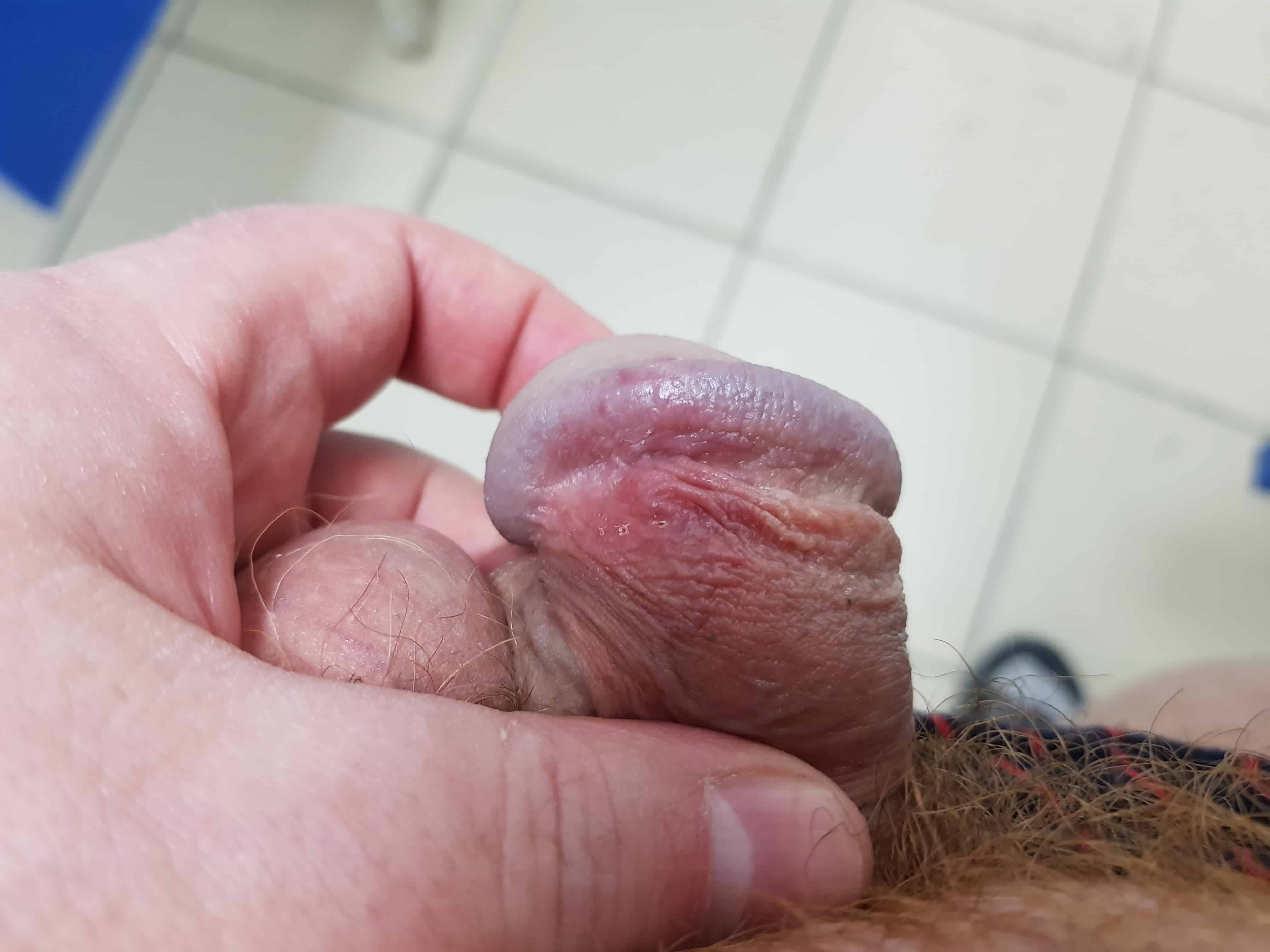 Roter ausschlag penis