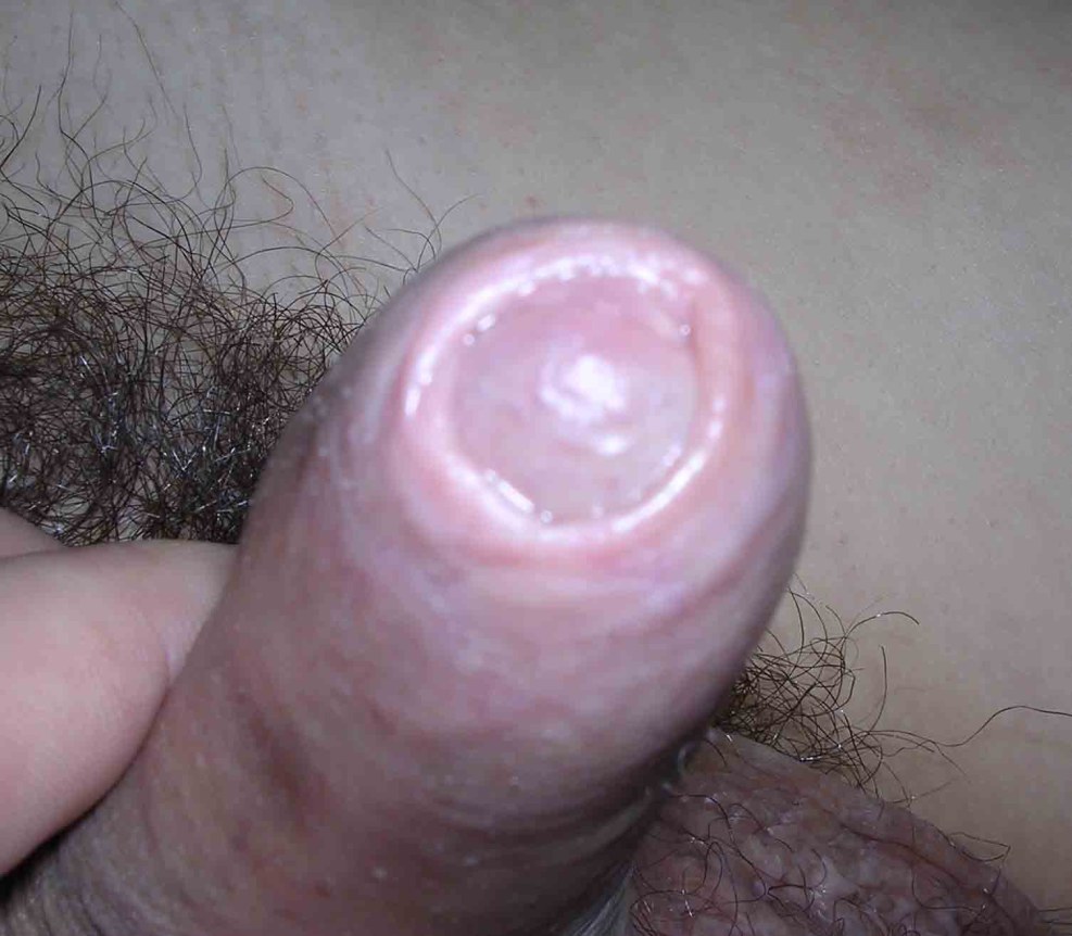 Autocircumcision with Silicone Glans Ring