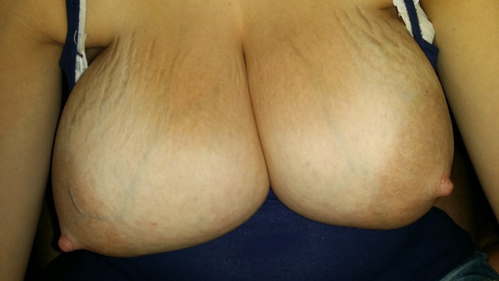 The Most Beautiful Set Of ENGORGED BREASTS EVER