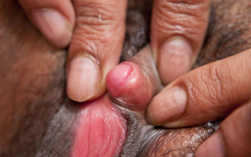 Homemade pump for the clitoris