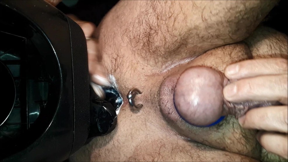 Anal tunnel in anus
