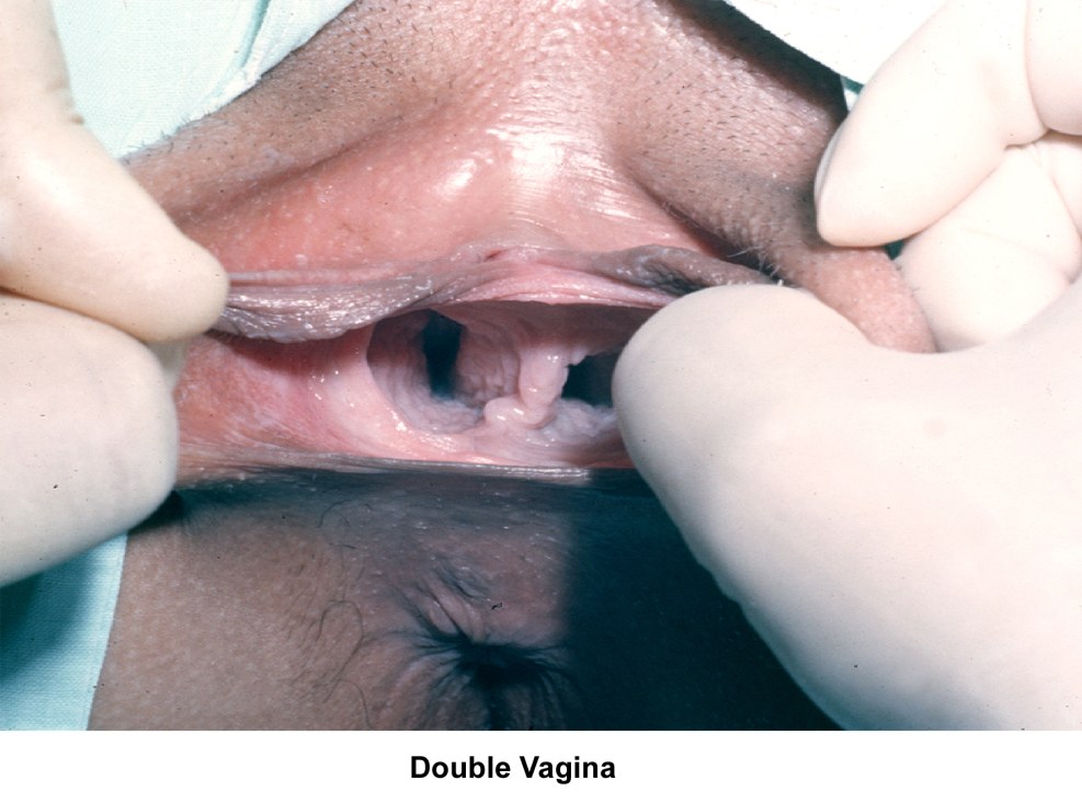 Two vagina for one girl