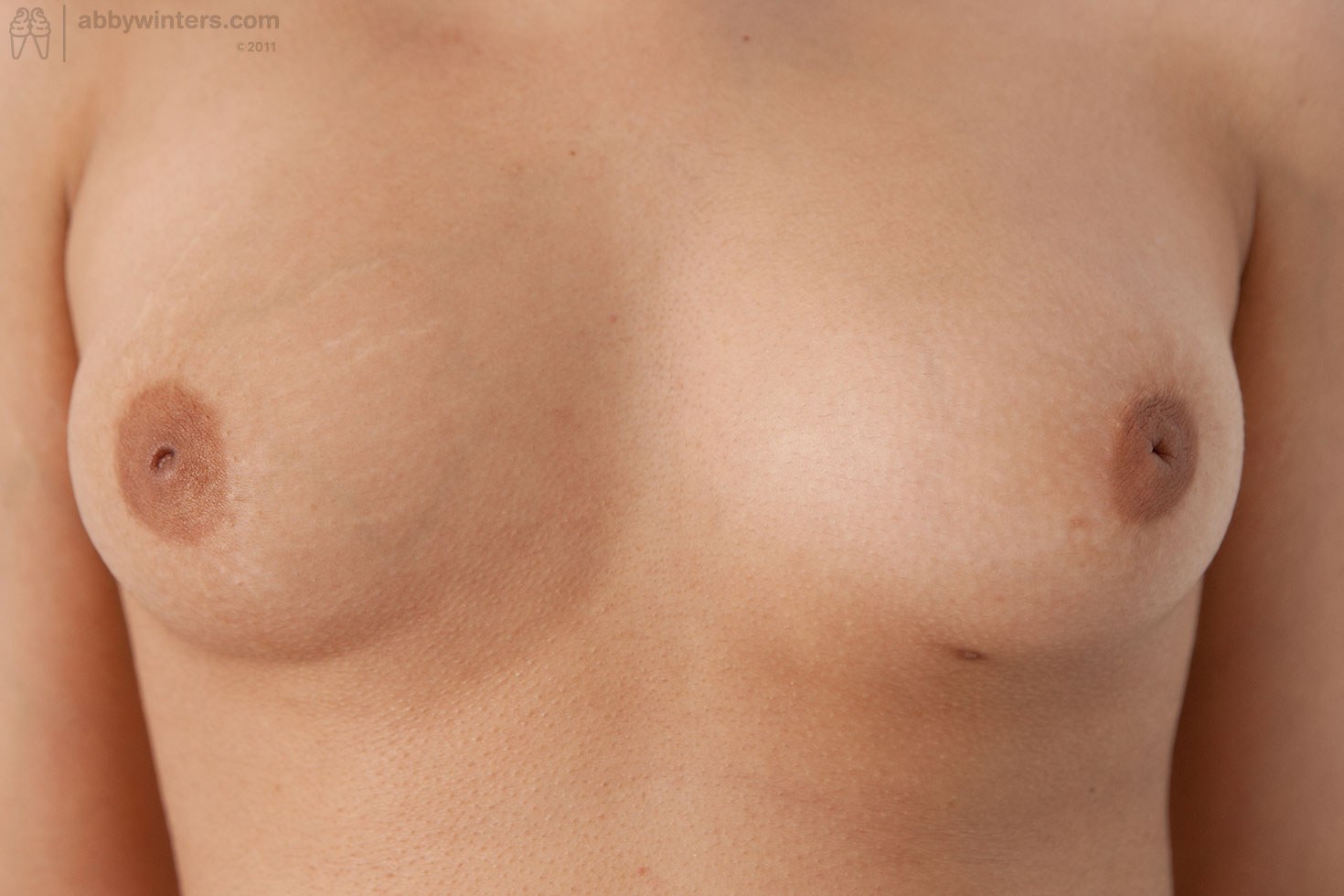 Inverted nipples teenager