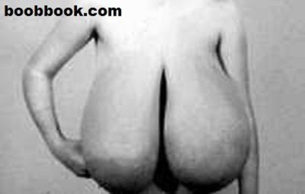 Macromastia in women