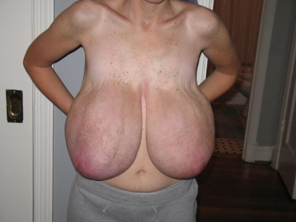 Giantomastia Pathology