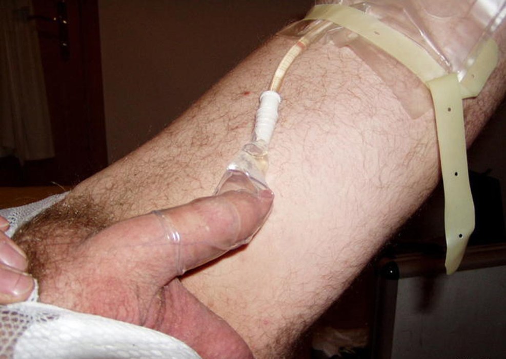 Catheter in the urethra female