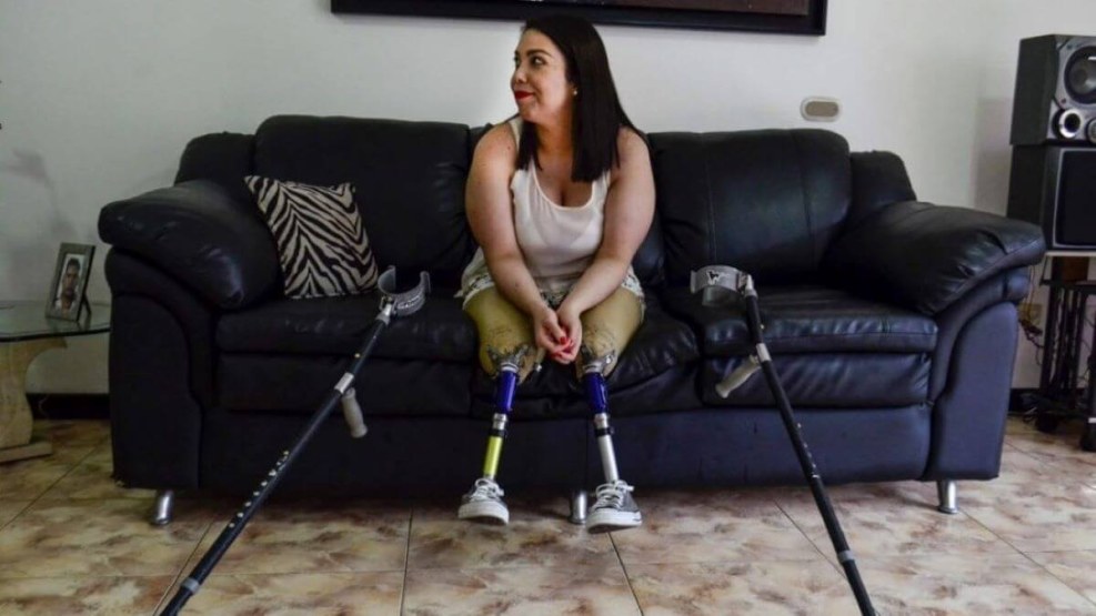 Svetik Kuleshova woman amputa