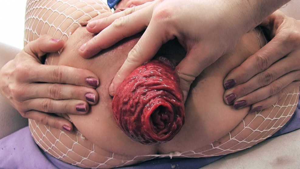 Svetlana Korlyakova Anal Prolapse