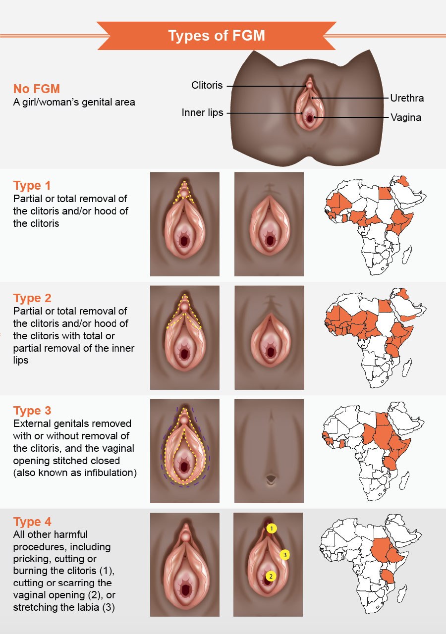 Female circumcision of Vulva's photo