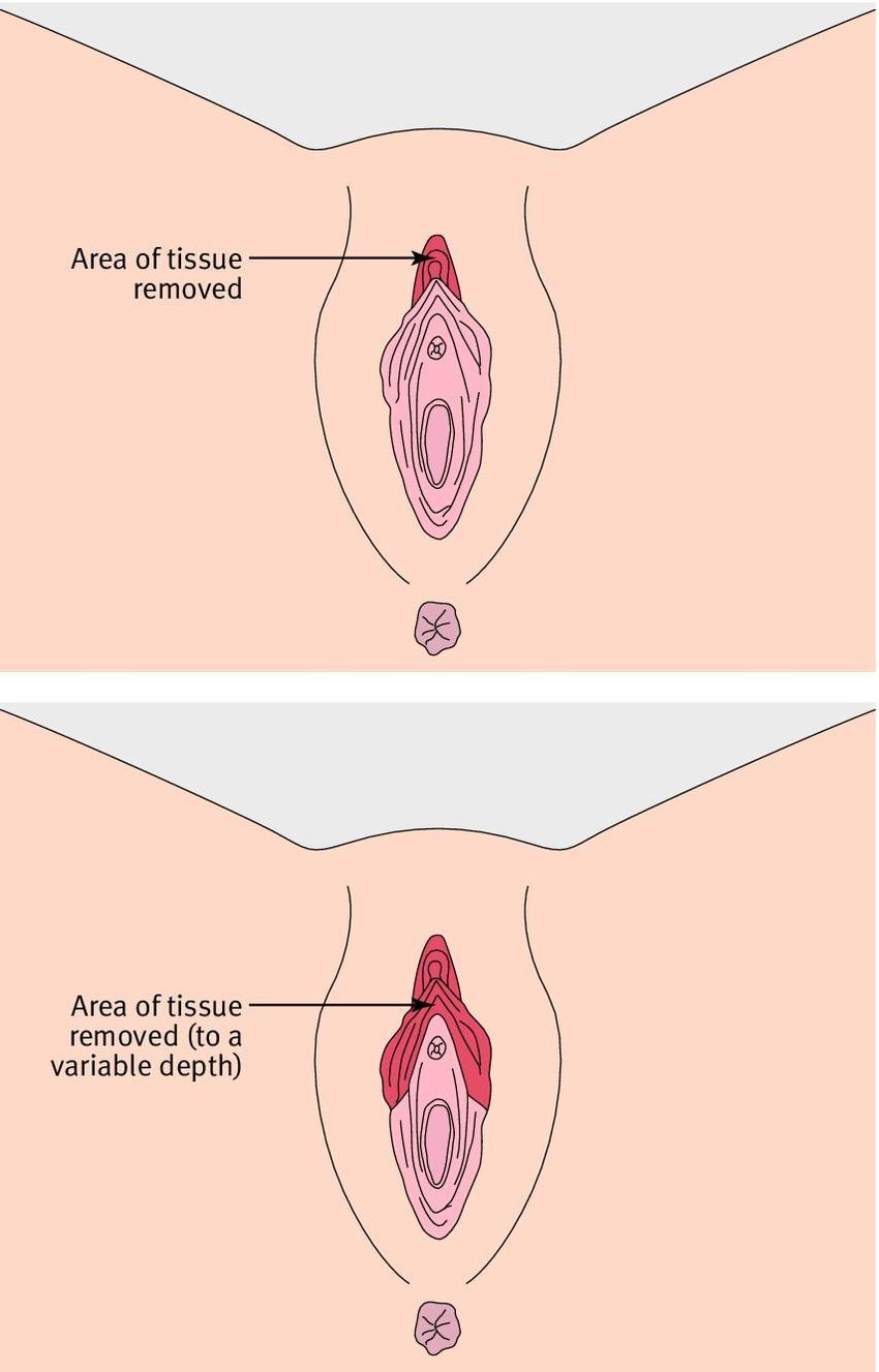 GENATAL MUTILATION (64 photos)