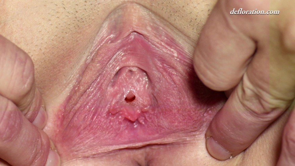 Deprivation of virginity