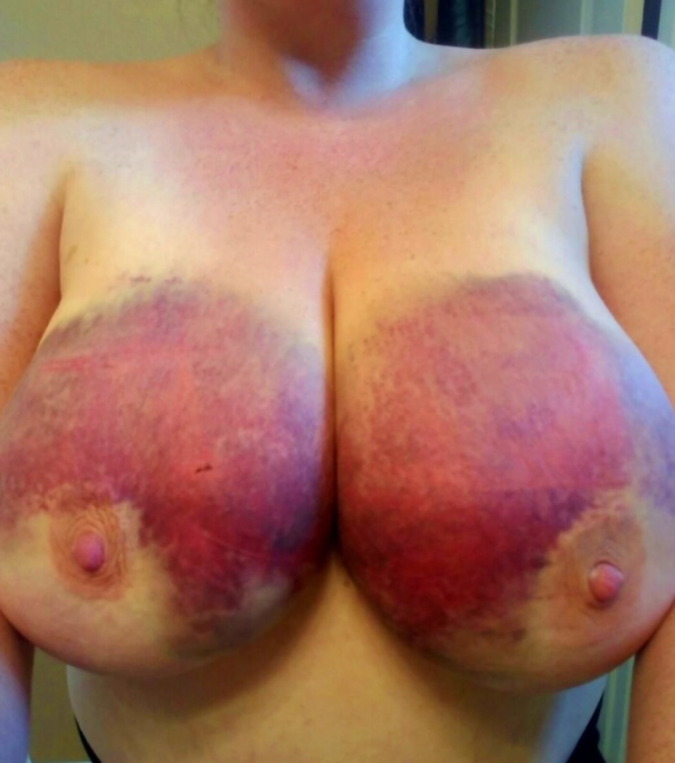 Big women's boobs in bruises